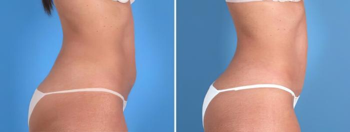 Mini Tummy Tuck Before & After Case 25674