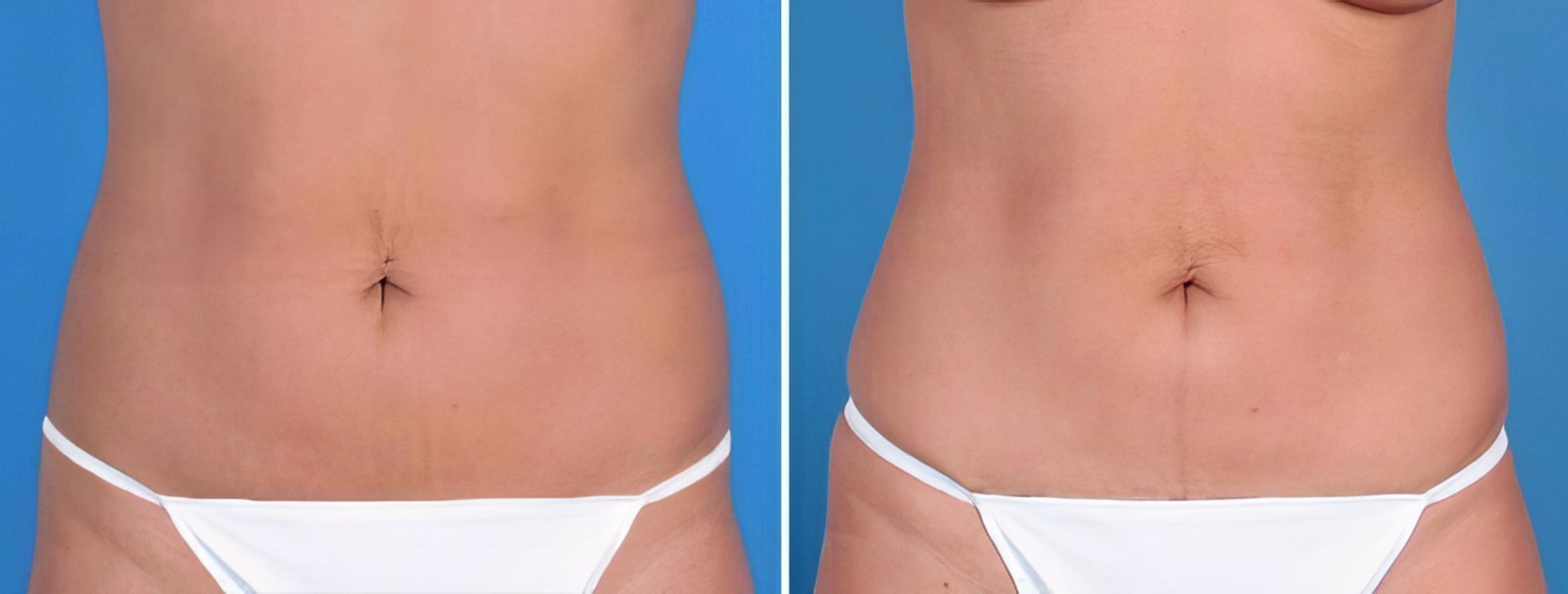 Mini Tummy Tuck Before & After Case 25683