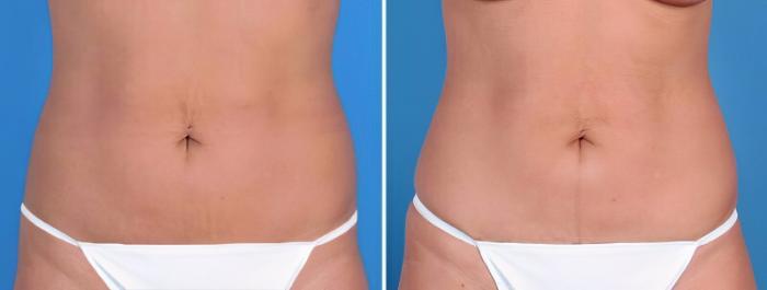 Mini Tummy Tuck Before & After Case 25683