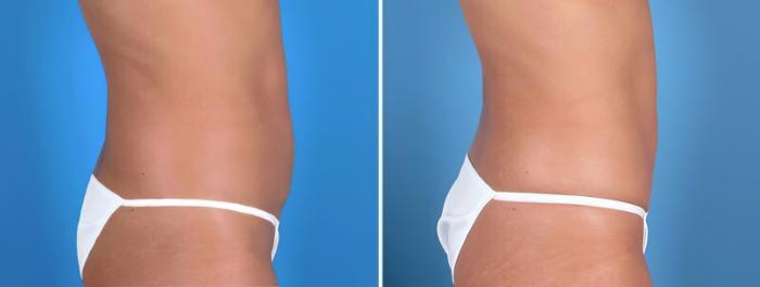 Mini Tummy Tuck Before & After Case 25683