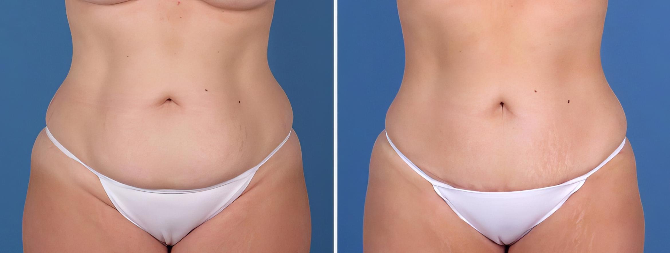 Mini Tummy Tuck Before & After Case 26798