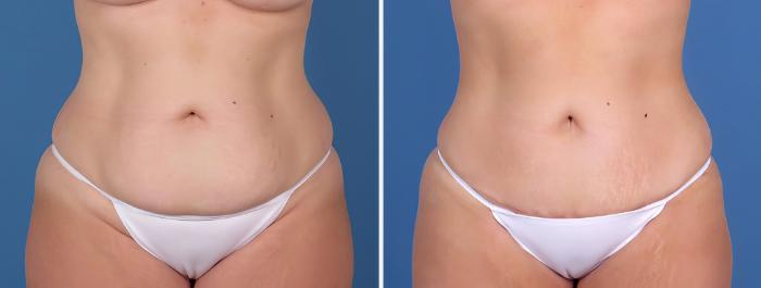 Mini Tummy Tuck Before & After Case 26798