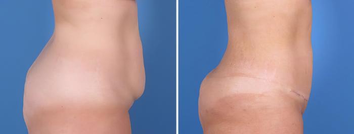Mini Tummy Tuck Before & After Case 26798