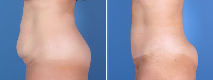 Mini Tummy Tuck Before & After Case 26798
