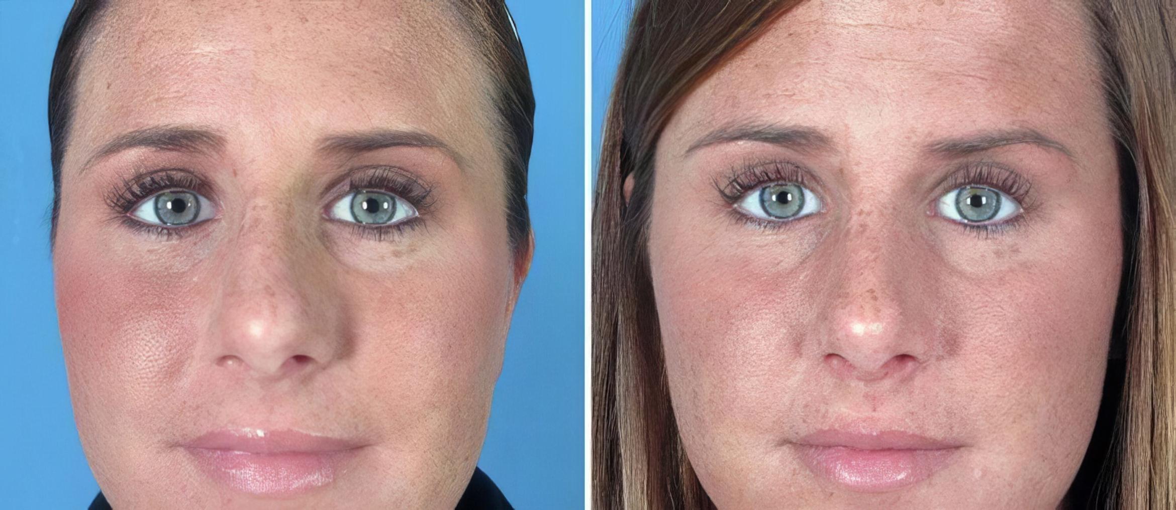 Rhinoplasty Before & After Case 17664