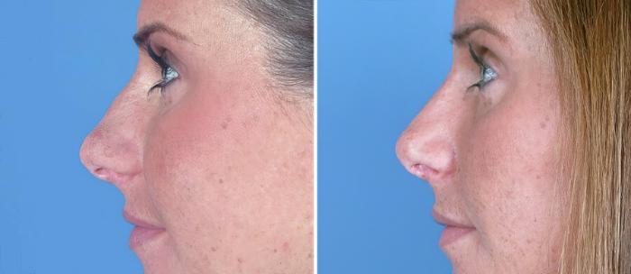 Rhinoplasty Before & After Case 17664