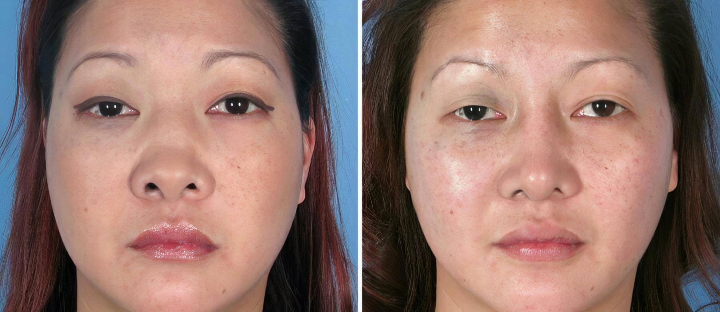 Rhinoplasty Before & After Case 17673
