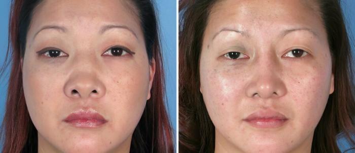 Rhinoplasty Before & After Case 17673