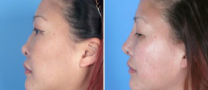 Rhinoplasty Before & After Case 17673