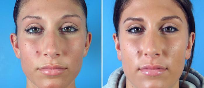 Rhinoplasty Before & After Case 17676