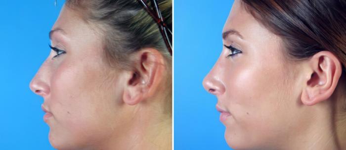 Rhinoplasty Before & After Case 17676