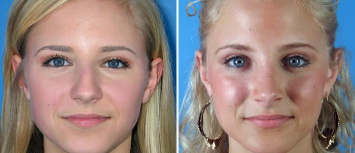 Rhinoplasty Before & After Case 17679