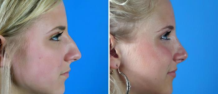 Rhinoplasty Before & After Case 17679