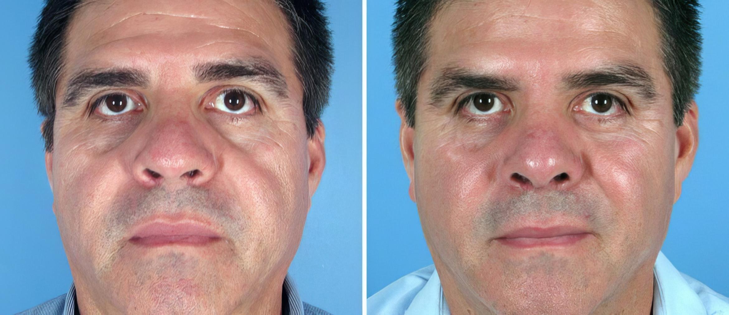 Rhinoplasty Before & After Case 17682