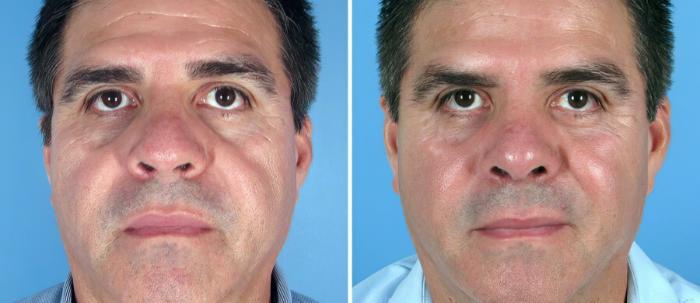 Rhinoplasty Before & After Case 17682
