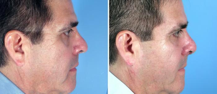 Rhinoplasty Before & After Case 17682