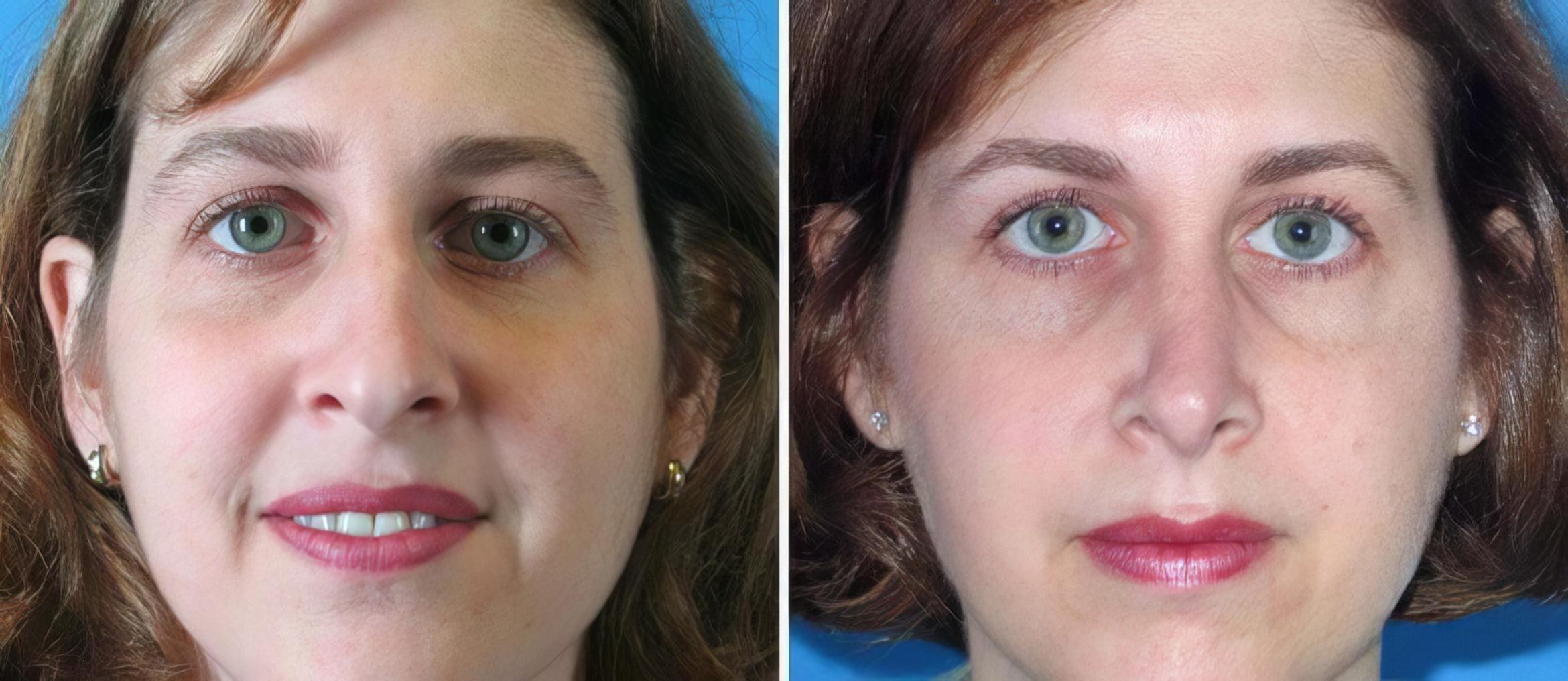 Rhinoplasty Before & After Case 17685