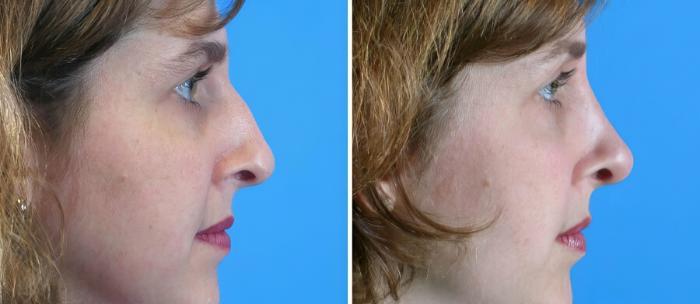 Rhinoplasty Before & After Case 17685