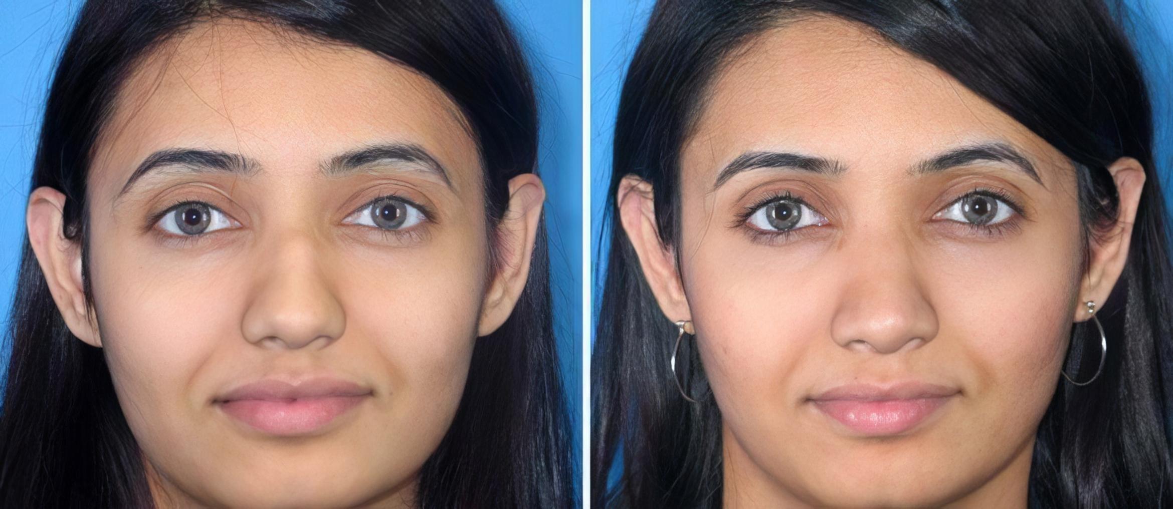 Rhinoplasty Before & After Case 17688