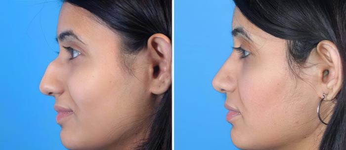 Rhinoplasty Before & After Case 17688
