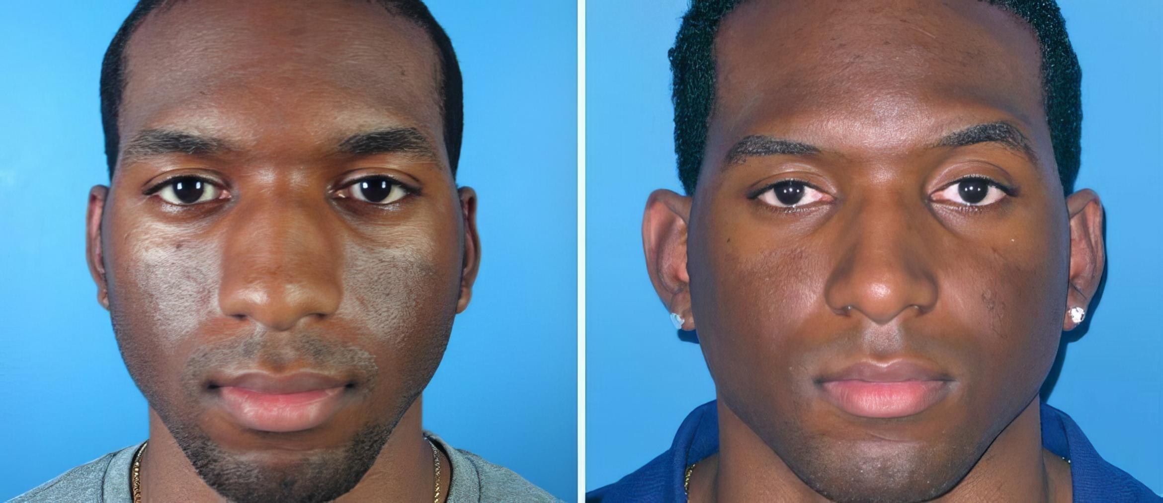 Rhinoplasty Before & After Case 17691
