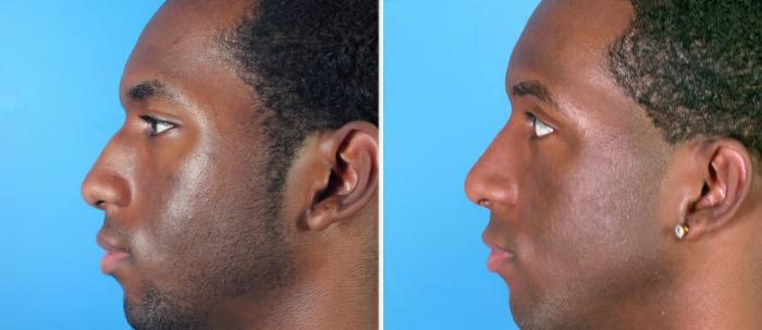 Rhinoplasty Before & After Case 17691