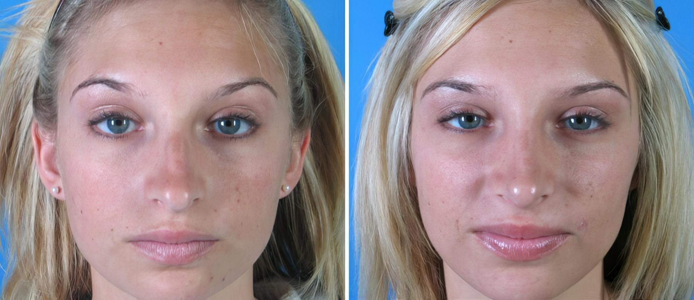 Rhinoplasty Before & After Case 18172