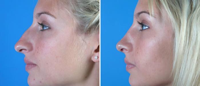 Rhinoplasty Before & After Case 18172