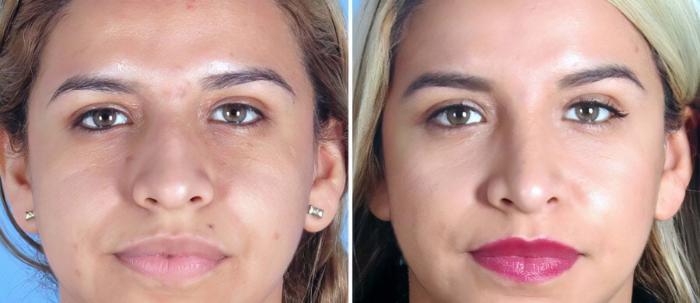 Rhinoplasty Before & After Case 19266