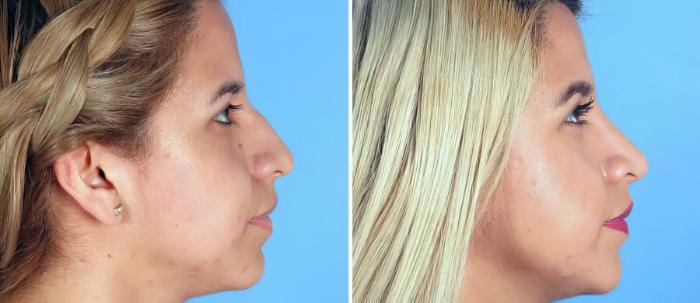 Rhinoplasty Before & After Case 19266