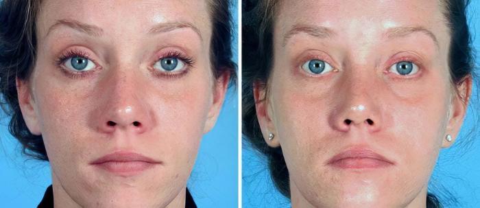 Rhinoplasty Before & After Case 19269