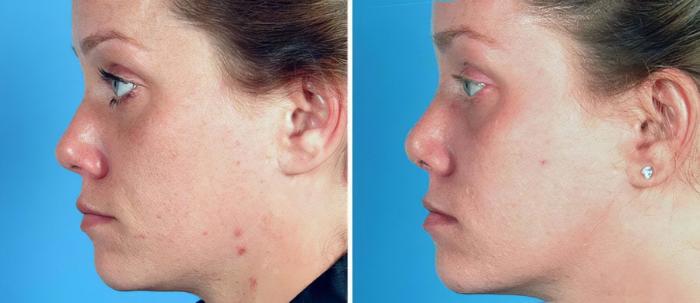 Rhinoplasty Before & After Case 19269