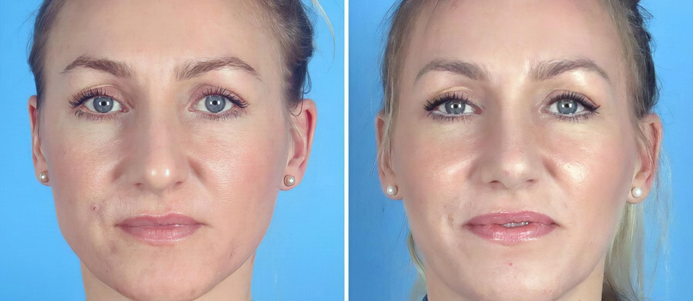 Rhinoplasty Before & After Case 19396