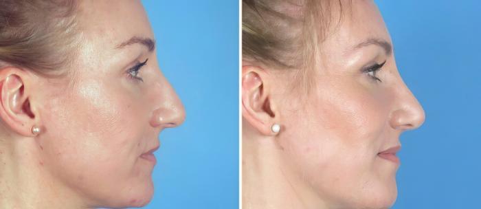 Rhinoplasty Before & After Case 19396