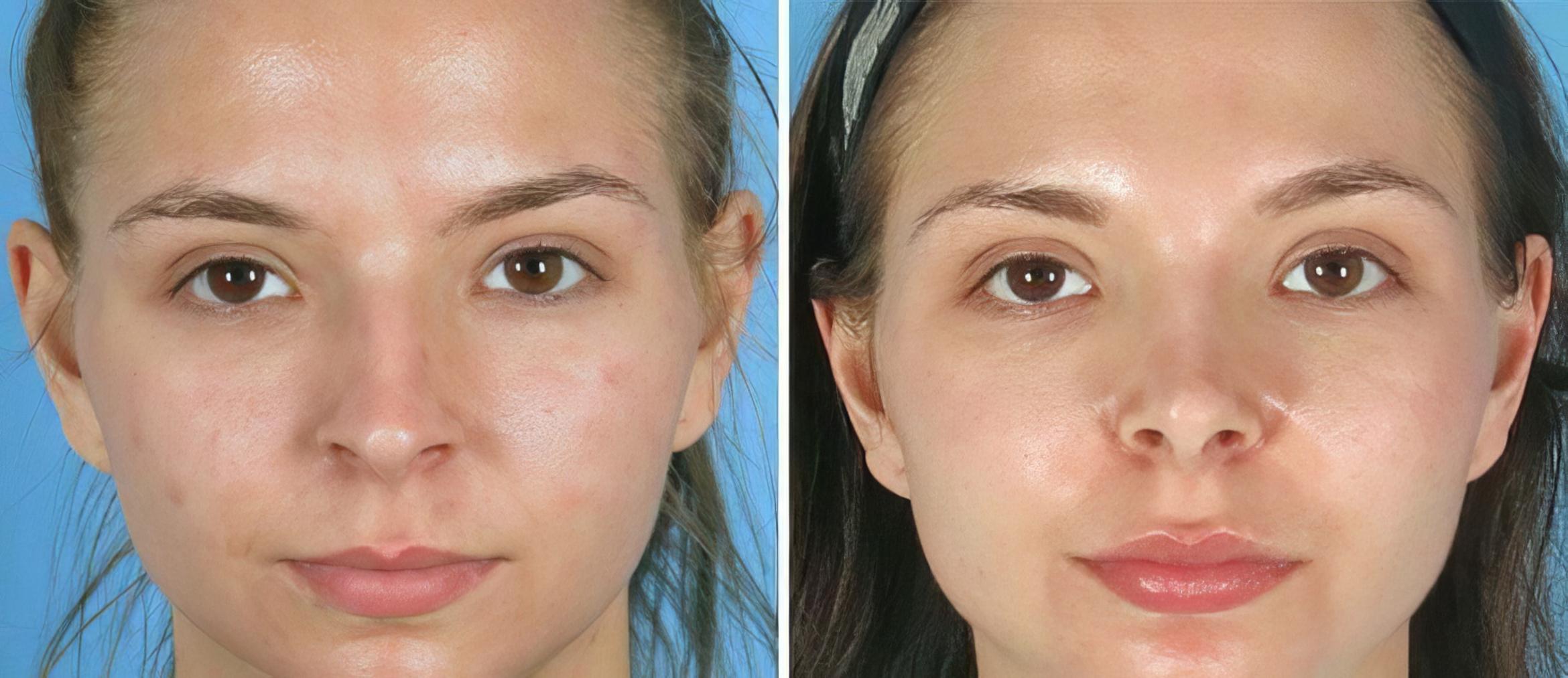 Rhinoplasty Before & After Case 19399