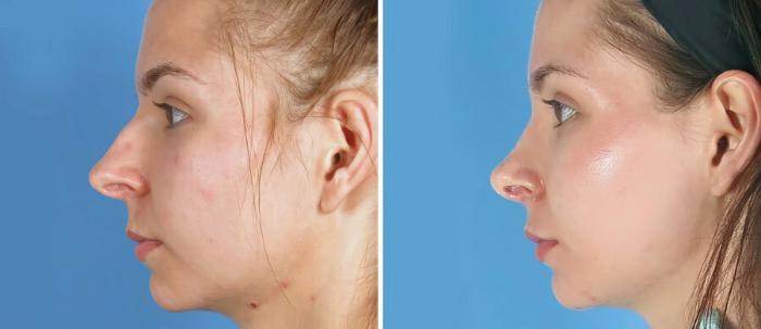 Rhinoplasty Before & After Case 19399