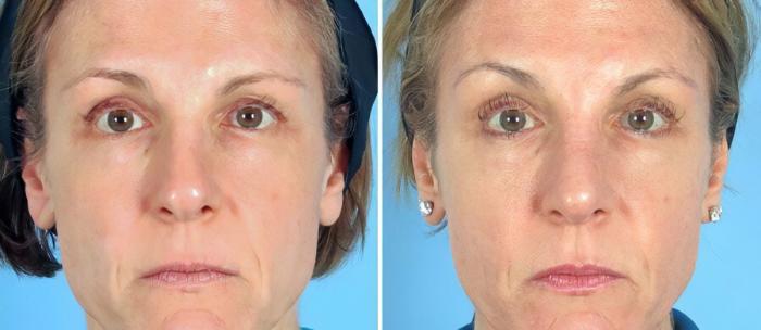 Rhinoplasty Before & After Case 19405