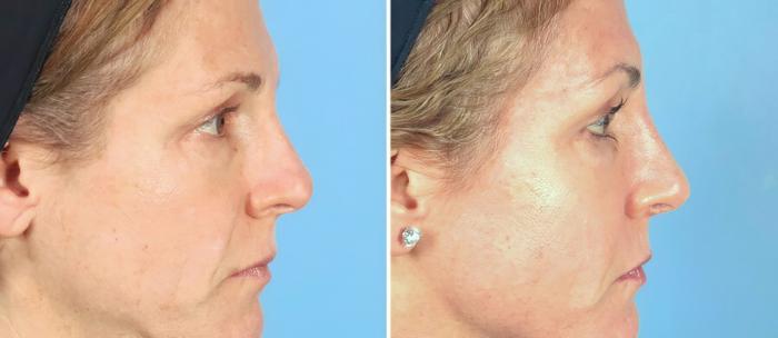 Rhinoplasty Before & After Case 19405