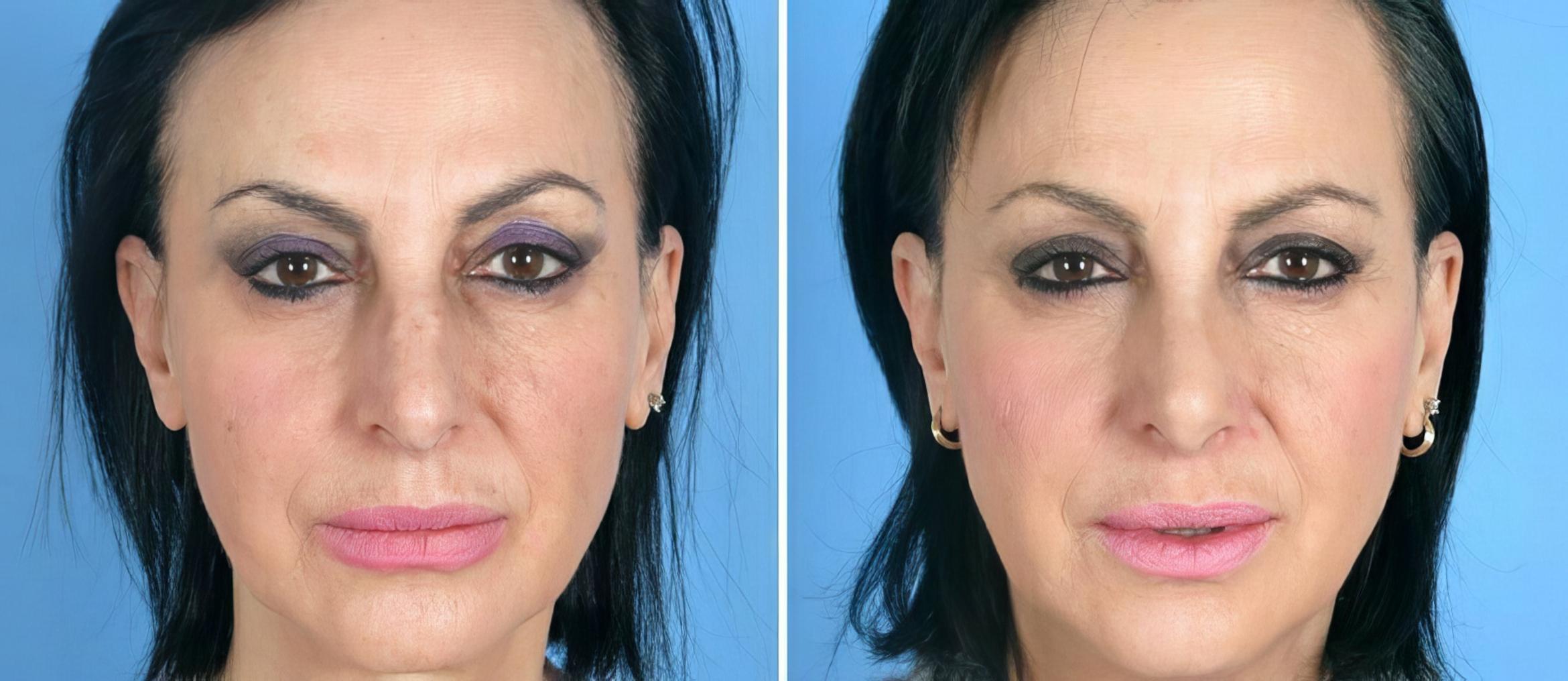 Rhinoplasty Before & After Case 19413