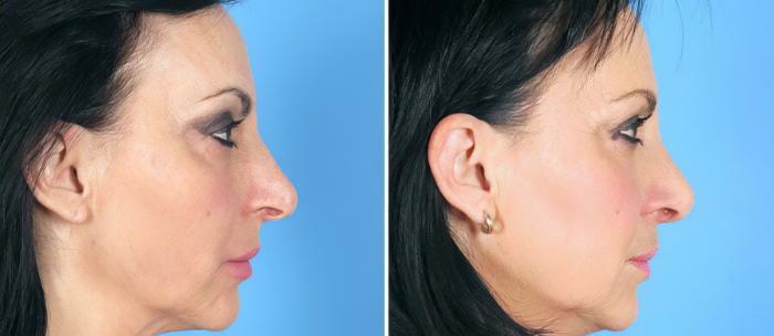 Rhinoplasty Before & After Case 19413