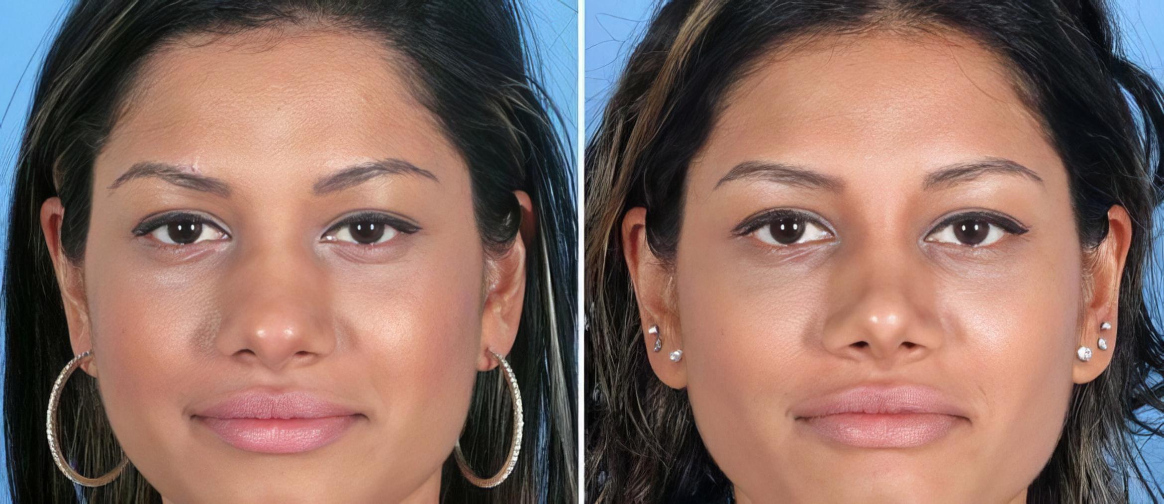 Rhinoplasty Before & After Case 19416