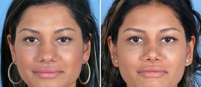 Rhinoplasty Before & After Case 19416