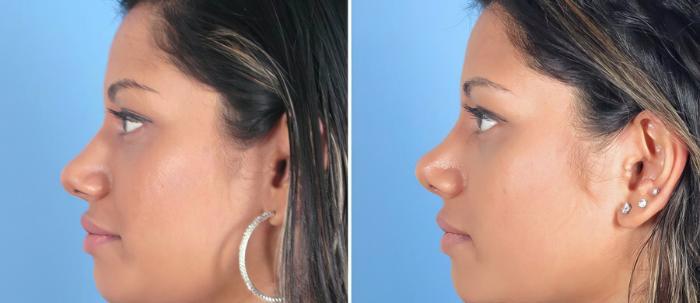Rhinoplasty Before & After Case 19416