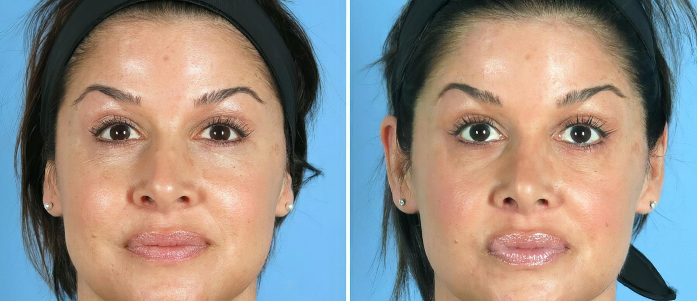Rhinoplasty Before & After Case 19419