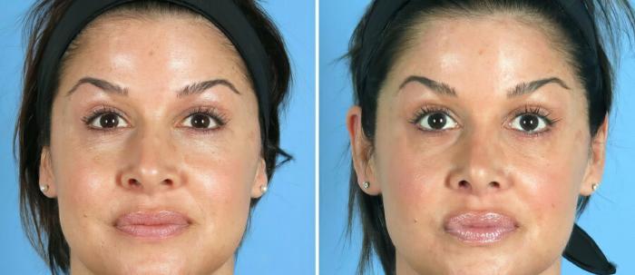 Rhinoplasty Before & After Case 19419