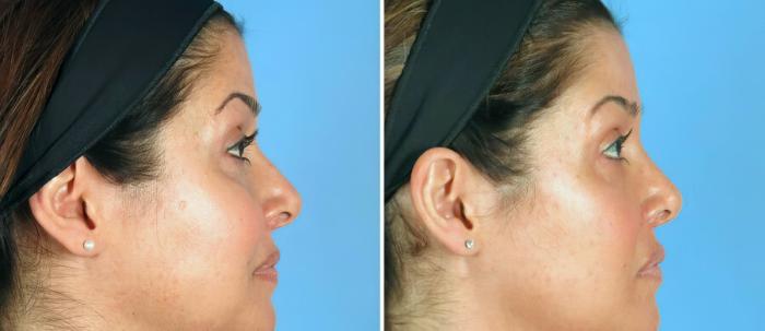 Rhinoplasty Before & After Case 19419