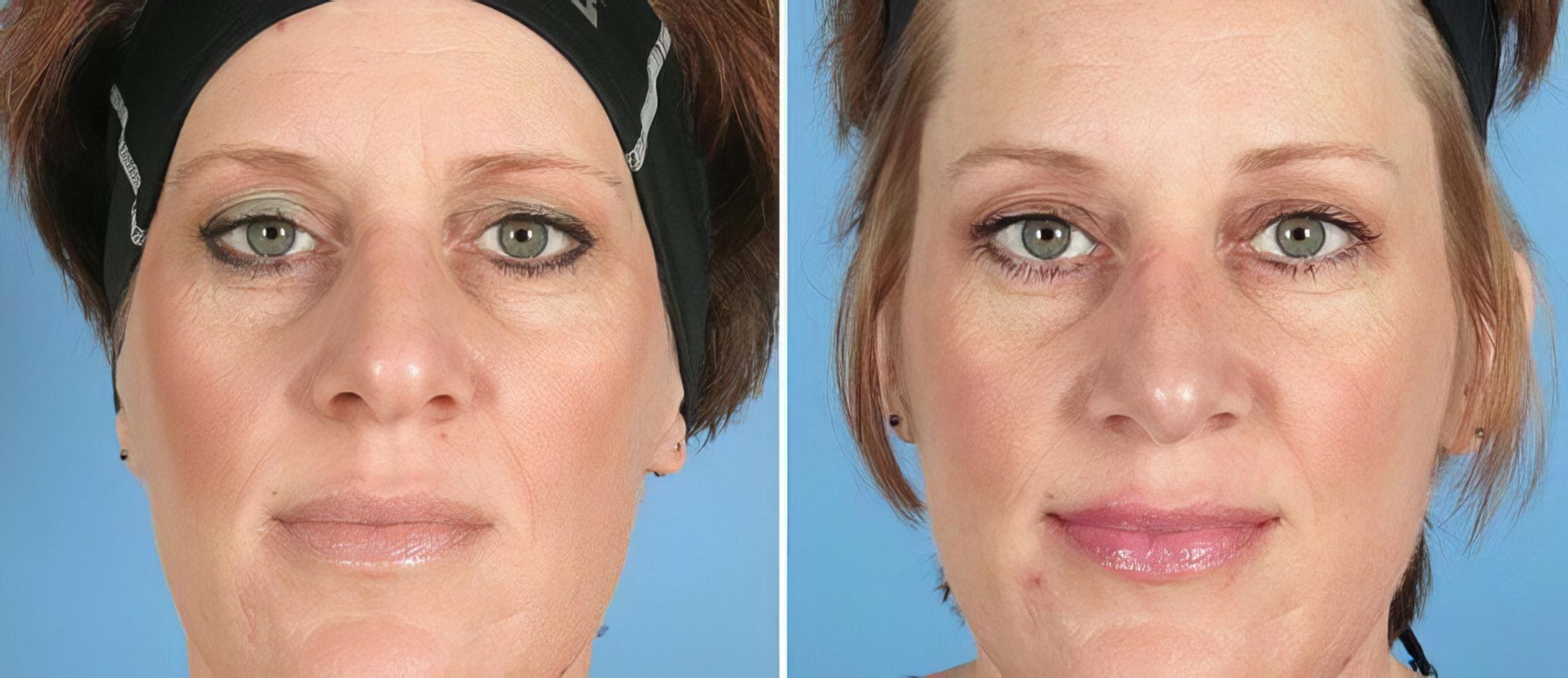 Rhinoplasty Before & After Case 19422