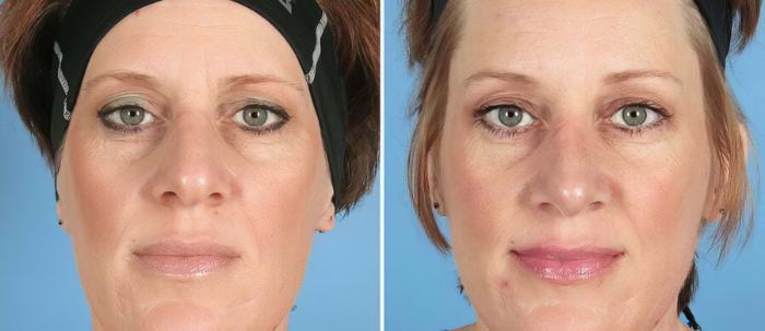Rhinoplasty Before & After Case 19422
