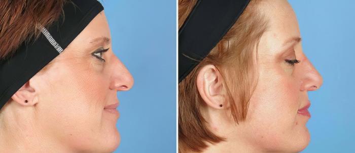 Rhinoplasty Before & After Case 19422