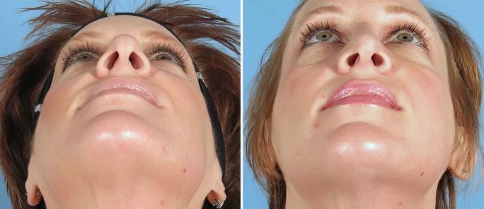 Rhinoplasty Before & After Case 19422